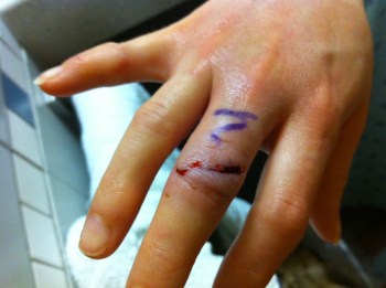 Post Surgery